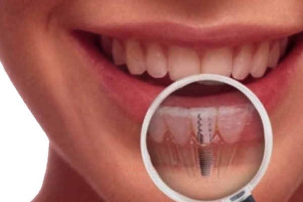 imagen de Implantes Dentales en Ciudad Real