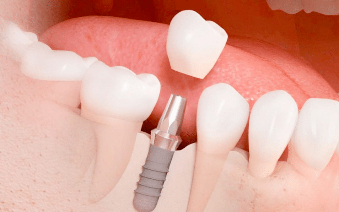 implantes dentales ciudad real
