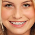 imagen de brackets-cerámica-ortodoncia-clinica-dental-madrid