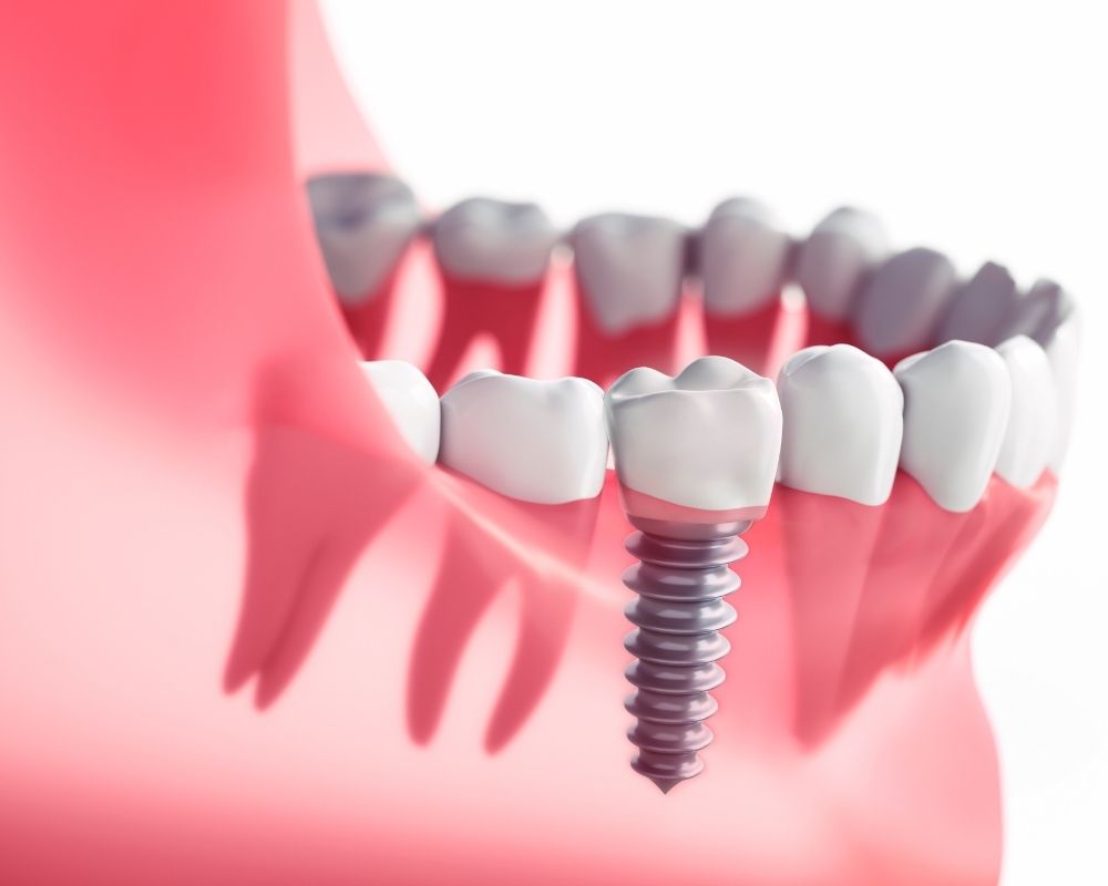 imagen de Implantes dentales o puentes dentales clinica dental en ciudad real